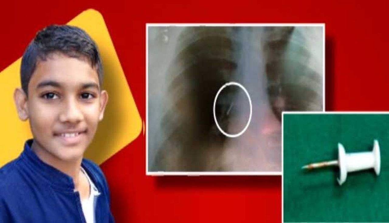 Odisha student death after swallowing a pin: Could he have been saved? Odisha student death after swallowing a pin: Could he have been saved?
